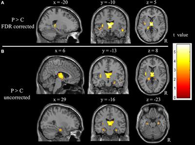Multimodal Data and Machine Learning for Detecting Specific Biomarkers in Pediatric Epilepsy Patients With Generalized Tonic-Clonic Seizures